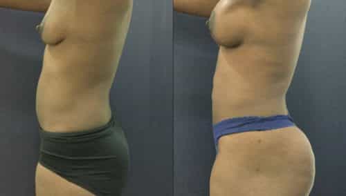 brazilian butt lift colombia 343-4-min