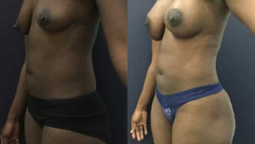 brazilian butt lift colombia 343-5-min