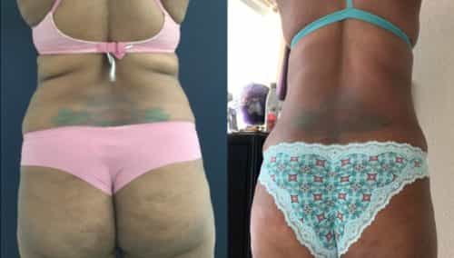 brazilian butt lift colombia 355-1-min