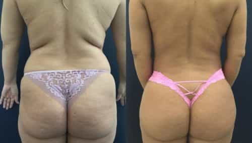 brazilian butt lift colombia 358-1-min