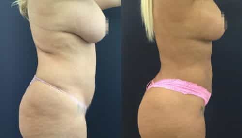 brazilian butt lift colombia 358-2-min