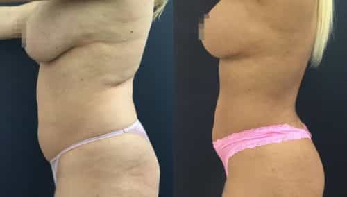 brazilian butt lift colombia 358-3-min