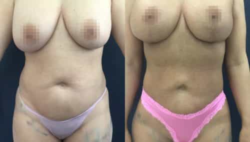 brazilian butt lift colombia 358-4-min