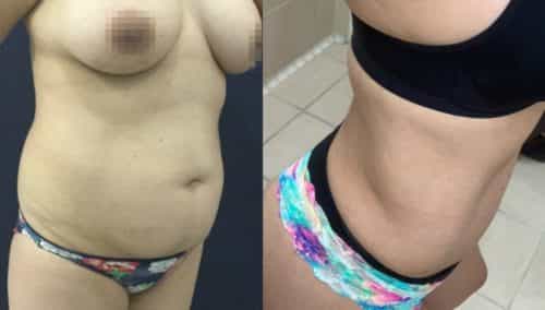 brazilian butt lift colombia 361-1-min