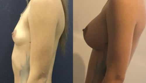 breast augmentation colombia 107-2-min