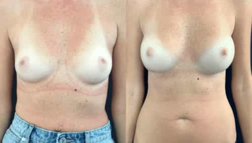 breast augmentation colombia 108-1-min