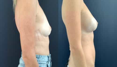 breast augmentation colombia 108-5-min