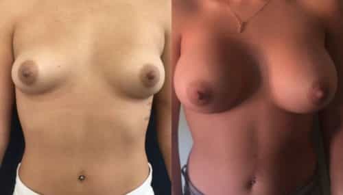 breast augmentation colombia 157-1-min