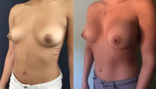 breast augmentation colombia 157-2-min