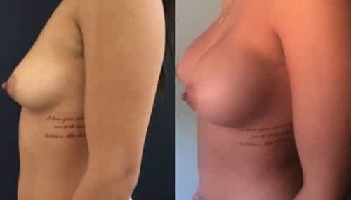 breast augmentation colombia 157-3-min
