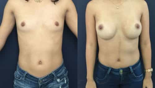 breast augmentation colombia 202-1-min