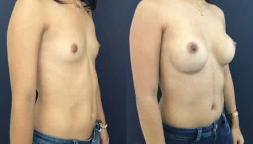 breast augmentation colombia 202-4-min