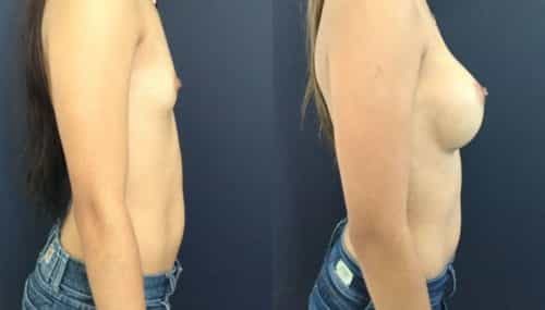 breast augmentation colombia 202-5-min