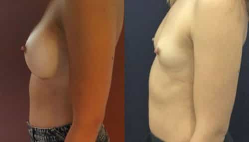 breast augmentation colombia 214-3-min