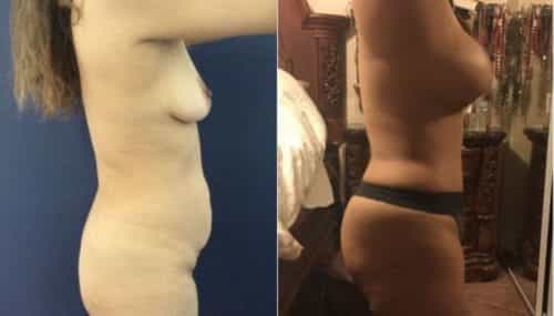 breast augmentation colombia 219-2-min