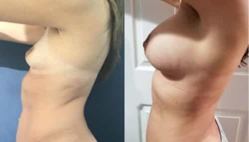 breast augmentation colombia 227-2-min