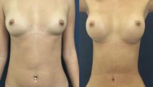 breast augmentation colombia 231-1-min