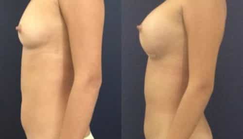 breast augmentation colombia 231-3-min