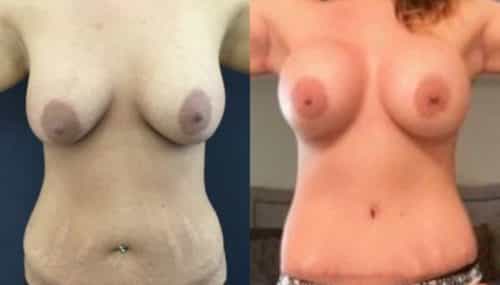 breast augmentation colombia 235-1-min