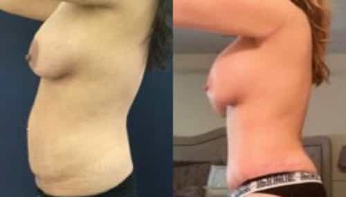 breast augmentation colombia 235-2-min