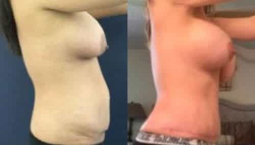 breast augmentation colombia 235-3-min