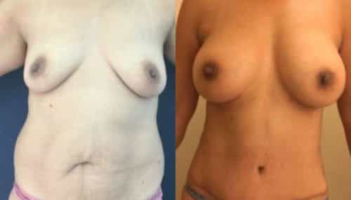 breast augmentation colombia 254-1-min