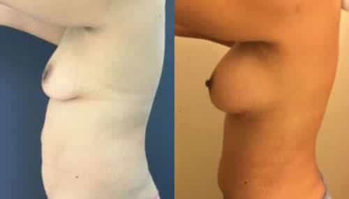 breast augmentation colombia 254-3-min
