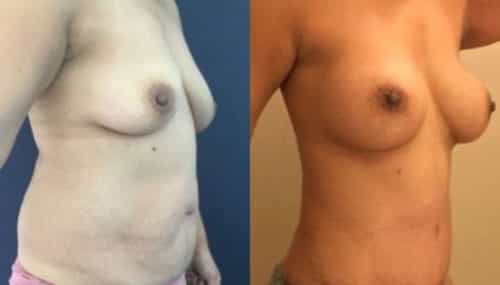 breast augmentation colombia 254-4-min