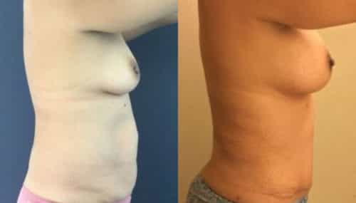breast augmentation colombia 254-5-min