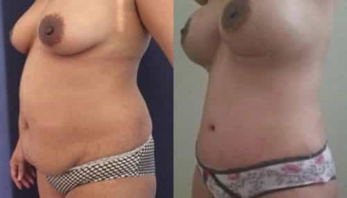 breast augmentation colombia 257-2-min