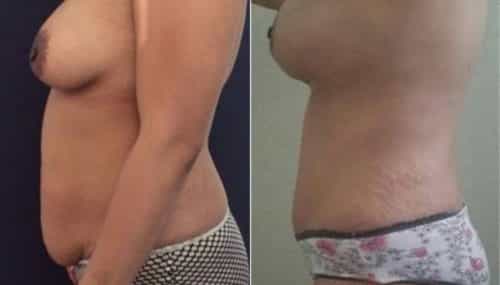 breast augmentation colombia 257-3-min