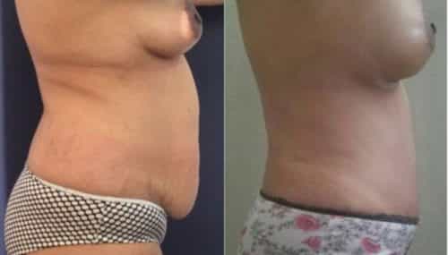 breast augmentation colombia 257-5-min