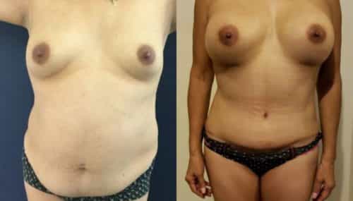 breast augmentation colombia 261-1-min