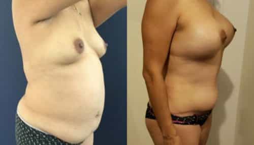 breast augmentation colombia 261-4-min