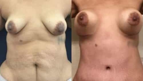 breast augmentation colombia 265-1-min