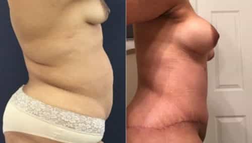 breast augmentation colombia 265-5-min