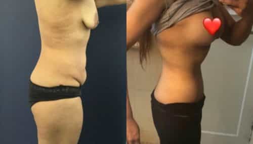 breast augmentation colombia 270-2-min