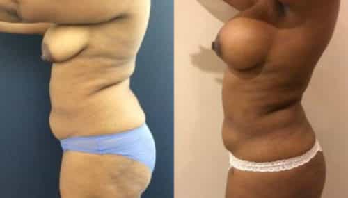 breast augmentation colombia 279-3-min
