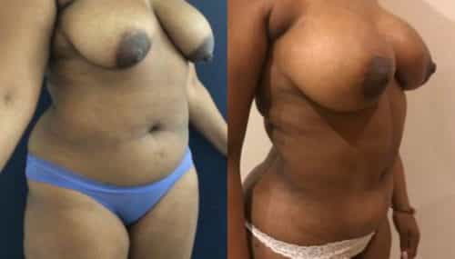 breast augmentation colombia 279-4-min