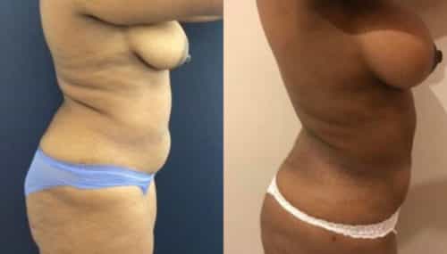 breast augmentation colombia 279-5-min