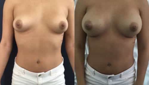breast augmentation colombia 292-1-min
