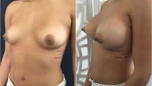 breast augmentation colombia 292-2-min