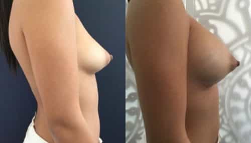 breast augmentation colombia 292-5-min