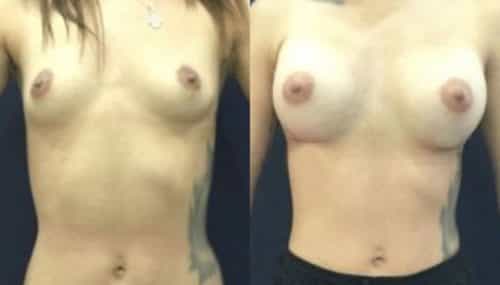 breast augmentation colombia 306-1-min