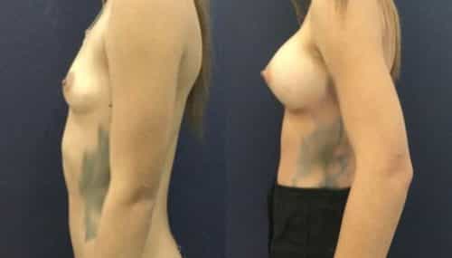 breast augmentation colombia 306-3-min