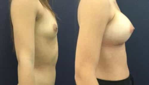 breast augmentation colombia 306-5-min
