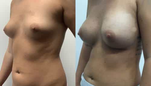 breast augmentation colombia 315-2-min
