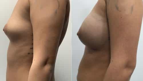 breast augmentation colombia 315-3-min