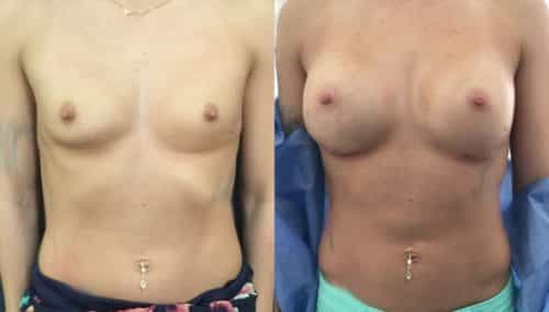 breast augmentation colombia 316-1-min