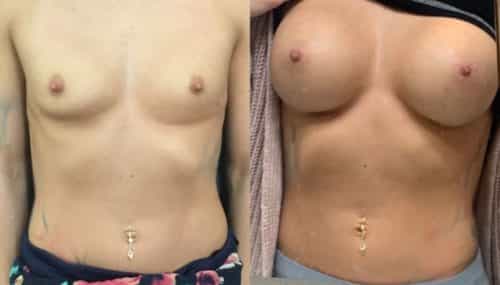 breast augmentation colombia 316-2-min